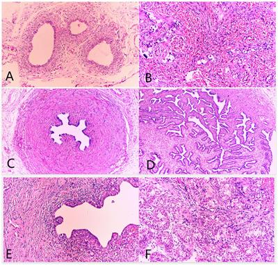 Disorder of Sexual Development Males With XYY in Blood Have Exactly X/XY/XYY Mosaicism in Gonad Tissues